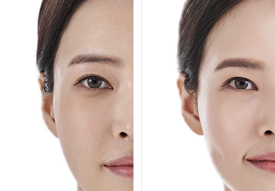 Resultados do tratamento na face